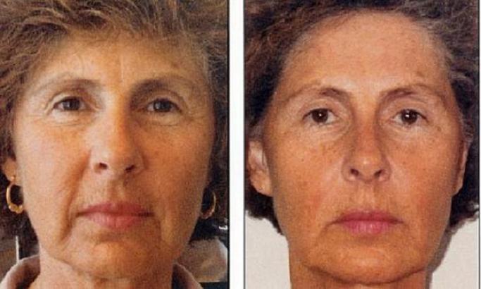 Micro Current Facial Lifting